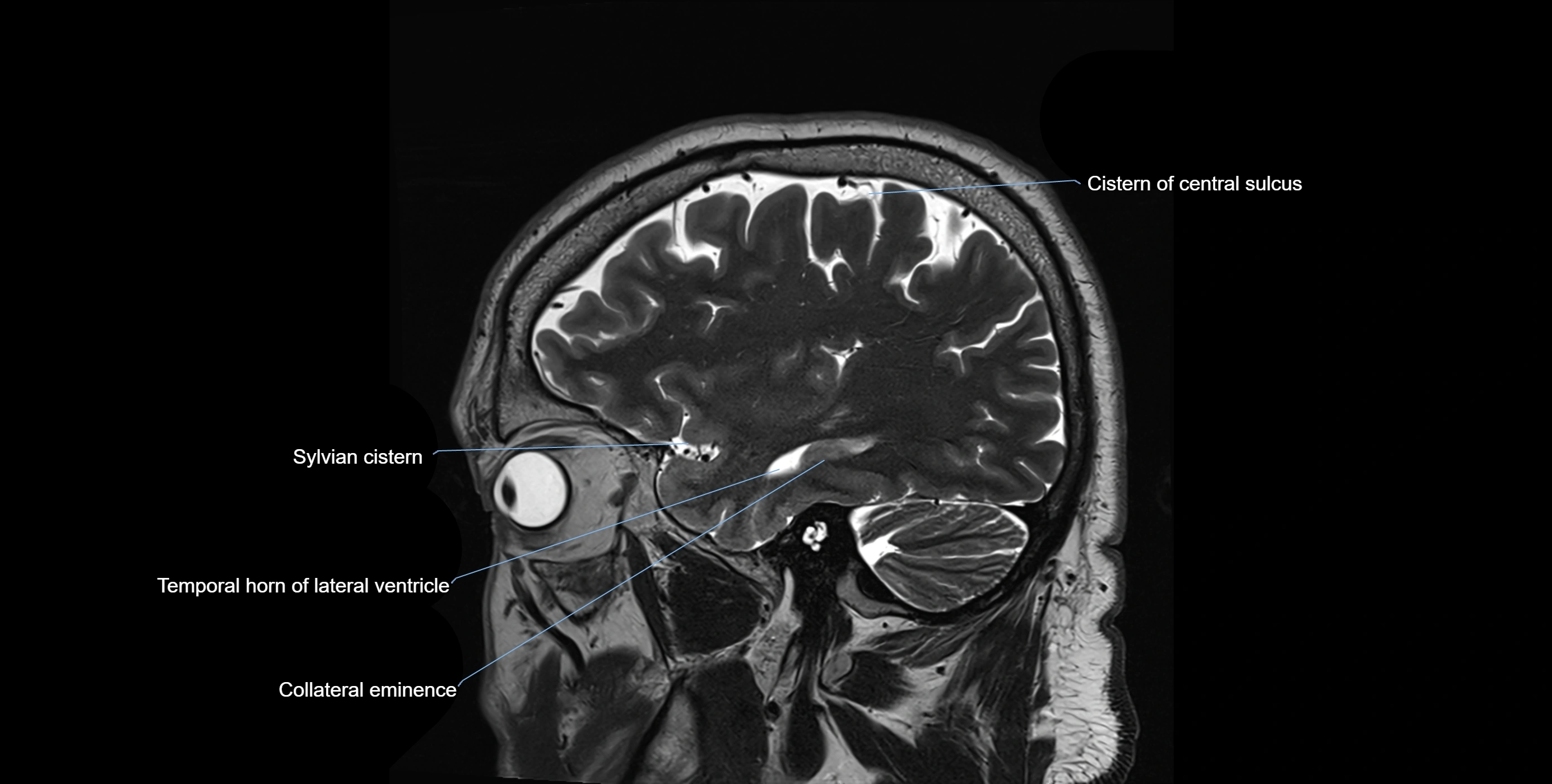 Brain cisterns  and ventricles sagittal anatomy 3T MRI image-img-00001-00013.webp